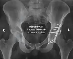 Posterior wall fracture fixed with screws and plate