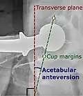 Acetabular anteversion.[96] This parameter is calculated on a lateral radiograph as the angle between the transverse plane and a line going through the (anterior and posterior) margins of the acetabular cup.[96]