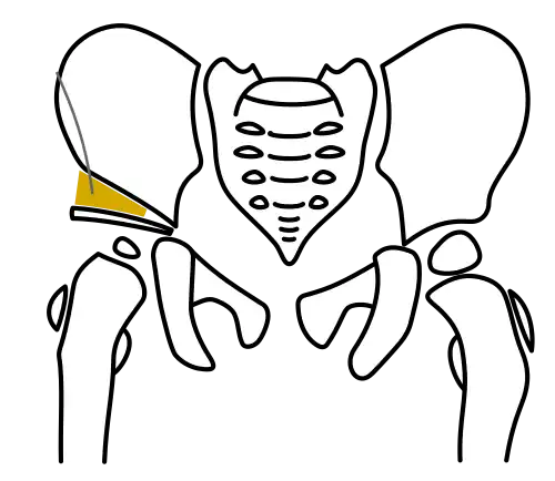 Acetabuloplasty, Step 4: Optional fixation with a Kirschner wire