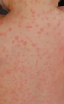 Nonallergic amoxicillin rash eight days after first dose: This photo was taken 24 hours after the rash began.