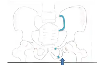 This fracture is best viewed anteriorly, while the other fractures are viewed superiorly. The arrow indicates where the force is coming from, and the colored lines indicate where the break occurs.