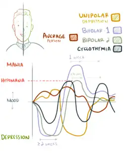 A graph showing mood lability. A person without bipolar disorder experiences a variety that never reaches hypomania or depression. Bipolar type 1 involves a manic episode. Bipolar type 2 involves depressive and hypomanic episodes. Cyclothymia involves hypomania and semi-depressive episodes. Unipolar depression involves periods of depression with some normal moods.