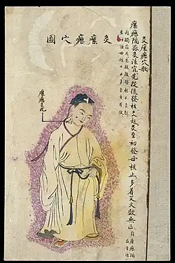 Scrofula was to be treated at the point where it occurred, with garlic-partition moxibustion (gesuan jiufa).