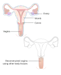 A radical hysterectomy for vaginal cancer with reconstruction of the vagina using other tissues