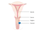 Stage 2 vaginal cancer