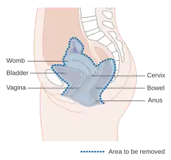 Diagram showing the area removed with a total operation