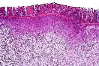 Low-power view of a dysgerminoma infiltrating the colonic wall, H&E stain.