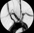 Aberrant right subclavian artery at angiography.