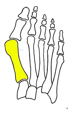 First metatarsal bone has moved aside