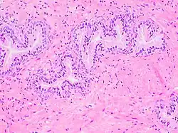 Histology of normal prostate, H&E stain, with benign features: Glands are rounded to irregularly branching, with an inner layer of epithelial cells surrounded by an outer layer of basal cells. They are surrounded by ample stroma.