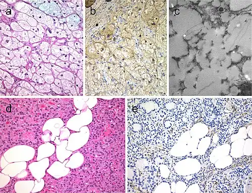 Lipid-rich follicular thyroid carcinoma (a) immunoreactive for thyroglobulin (b); the ultrastructural study evidenced numerous lipid vacuoles in the cytoplasm (ultrastructure) (c). Adenolipoma (lipoadenoma) in a patient with PTEN hamartoma tumor syndrome (d); there is negativity for PTEN protein in tumor cells while stromal cells (internal positive control) are positive (e)[9]