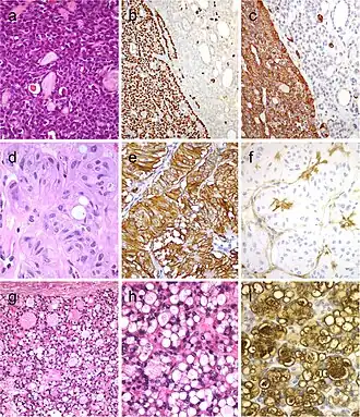 Tumor of the thyroid with solid cell nest features disclosing small cells of the main cell type (a) that express p63 (b) and cytokeratin 5 (c), in the absence of TTF1, calcitonin, and thyroglobulin expression. Hyalinizing trabecular tumor (d–f) is composed of trabeculae of elongated or polygonal cells admixed with abundant amounts of hyaline material negative for amyloid and positive for type IV collagen (f); Ki-67 is characteristically expressed in the cell membrane but not in the nuclei of the tumor cells (e). Follicular adenoma with signet ring cells (g and h), showing strong positivity for thyroglobulin (i)[9]
