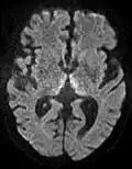 DWI showing restricted diffusion in the medial dorsal thalami consistent with Wernicke encephalopathy