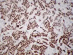 Immunohistochemistry of estrogen receptor in invasive breast cancer, showing nuclear staining.