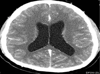 CT scan of neurocysticercosis and hydrocephalus