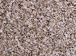 HIstopathology specimen of a glioblastoma, MAP2 immunostain.