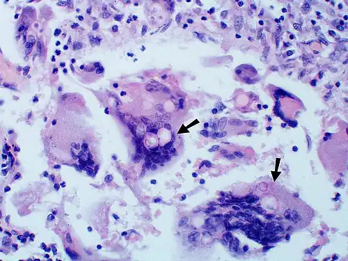 Large yeast-like fungi seen within giant cells at arrows. Budding yeasts in the cytoplasm of giant cells at the arrows. Broad-based budding and double-contoured cell walls are seen in the giant cell in the center are characteristic of Blastomyces dermatitidis.