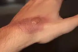 Blister