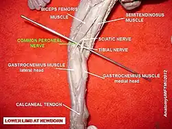 Common fibular (peroneal) nerve