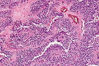 Histopathology of a solid pseudopapillary tumour. H&E stain. This case also shows the key feature of intracytoplasmic hyaline globules.
