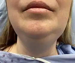 Swollen and hard area under the chin due to Ludwig's angina