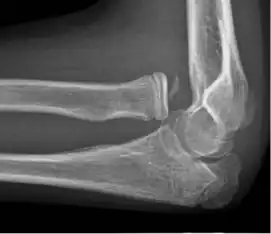X-ray of ventral dislocation of the radial head. There is calcification of annular ligament, which can be seen as early as 2 weeks after injury.[52]